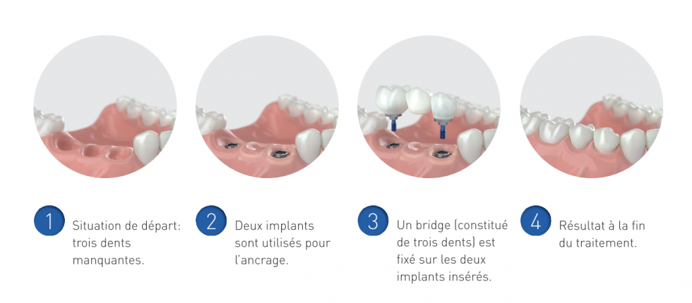 Couronnes Et Bridge Sur Implants Cabinet Dentaire Dr Delphine Reys