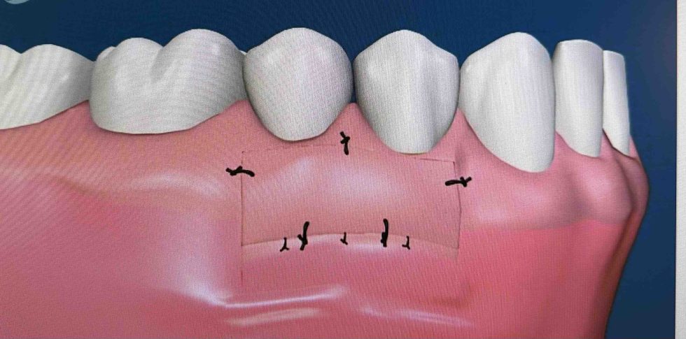 Les Greffes Gingivales Cabinet Dentaire Dr Delphine Reys